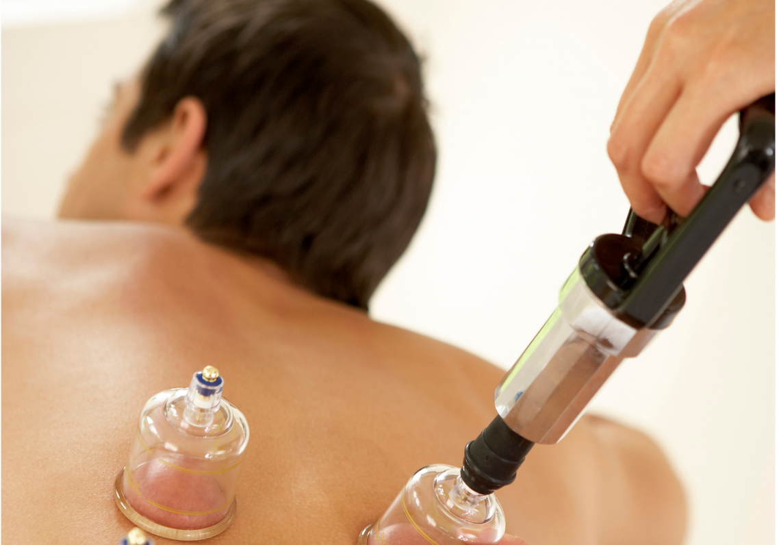 man receiving cupping therapy